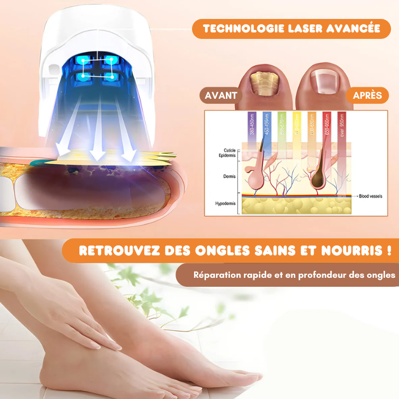 Appareil de traitement au laser pour ongles anti-mycose