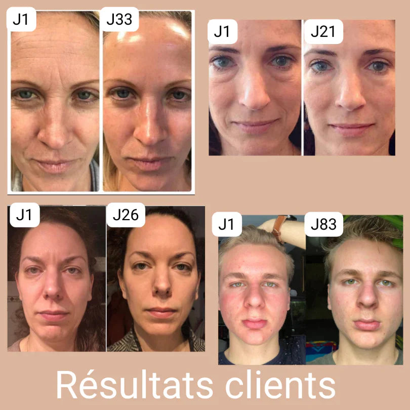 LUMILIFT - Appareil de soin visage luminothérapie